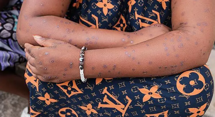 Güney Afrika'dan M çiçegi açiklamasi