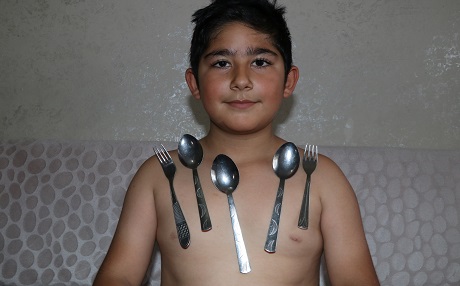 Batmanli çocugun vücudu metal çekiyor