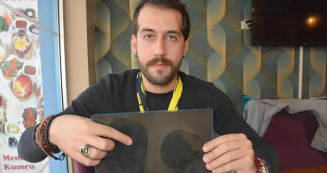 Tomografisi çekildi soke oldu! Beyninde dis çikti